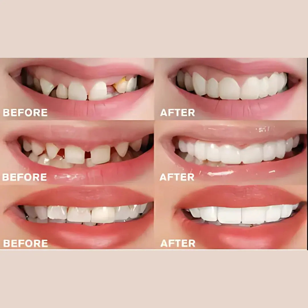 Advanced Cosmetic Teeth Denture (BUY 1 GET 1 FREE)